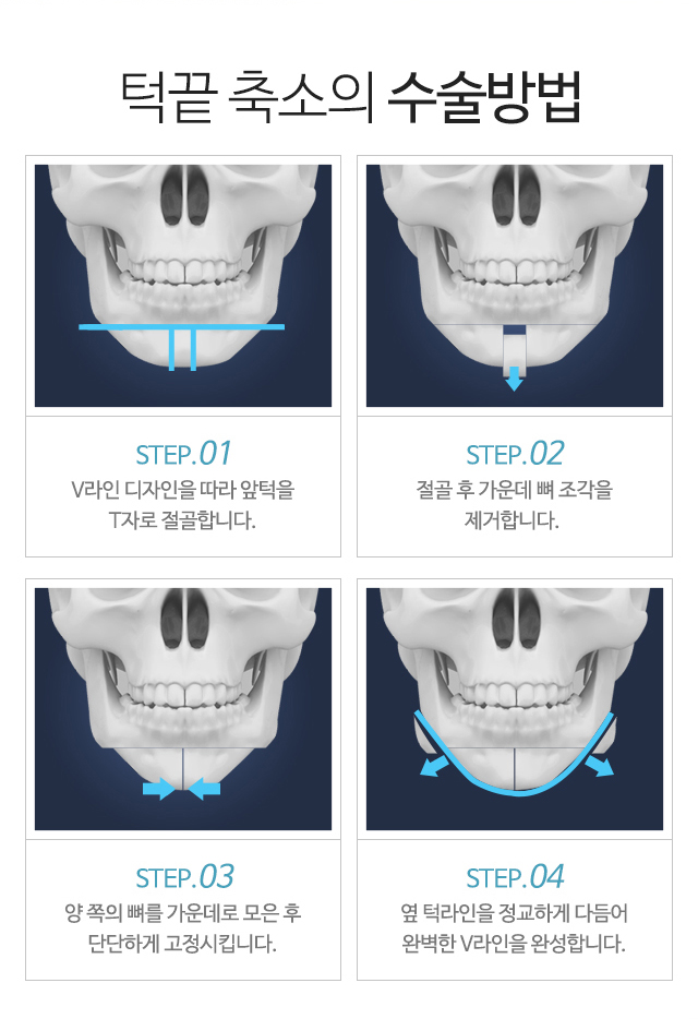 턱 끝 T절골 POINT:1)정면에서도 갸름한 V라인 2)비대칭 턱 끝 교정 3)얼굴이 작아지는 효과 4)턱 끝 수술과 사각 턱 수술병행